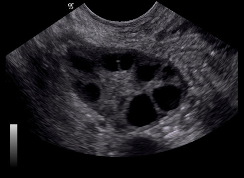 Fertility Treatments Ovulation Induction