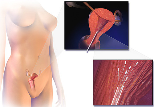 Fertility Treatments IUI